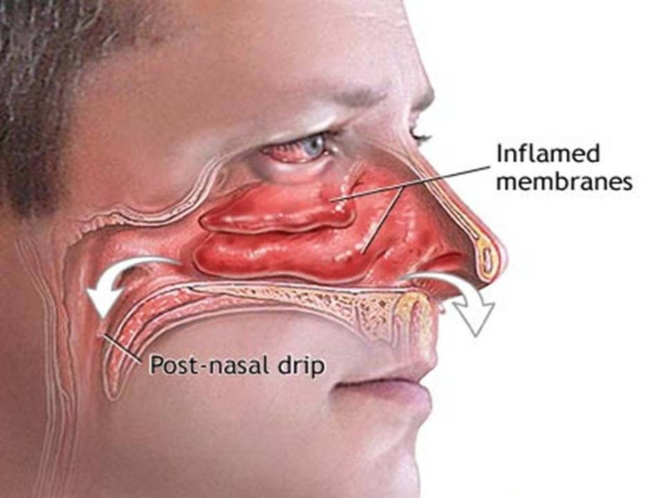 Атрезія хоан - порок розвитку, який полягає в повному закритті або ж звуження однієї або обох носових порожнин м'якотканинних або кістковою перегородкою